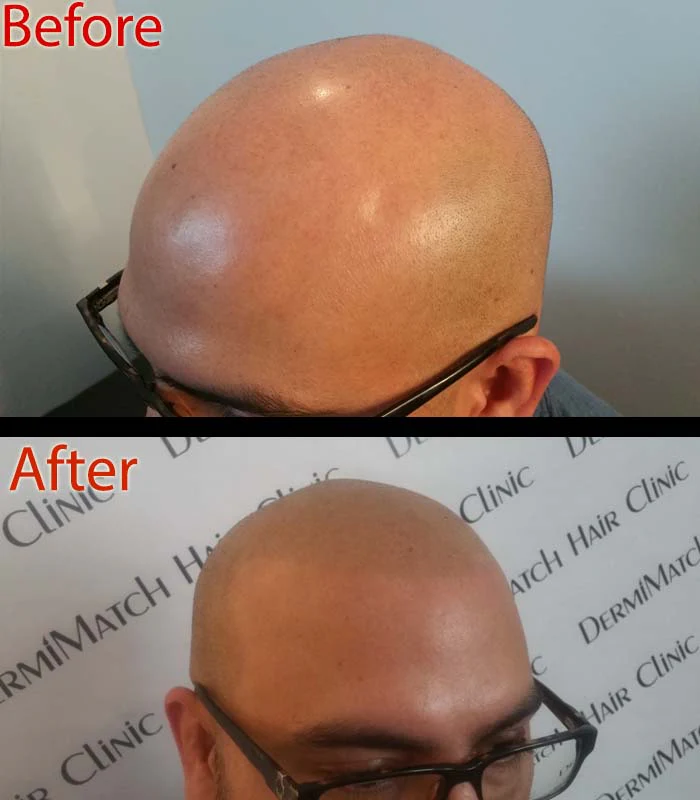 Master the Art of Scalp Micropigmentation