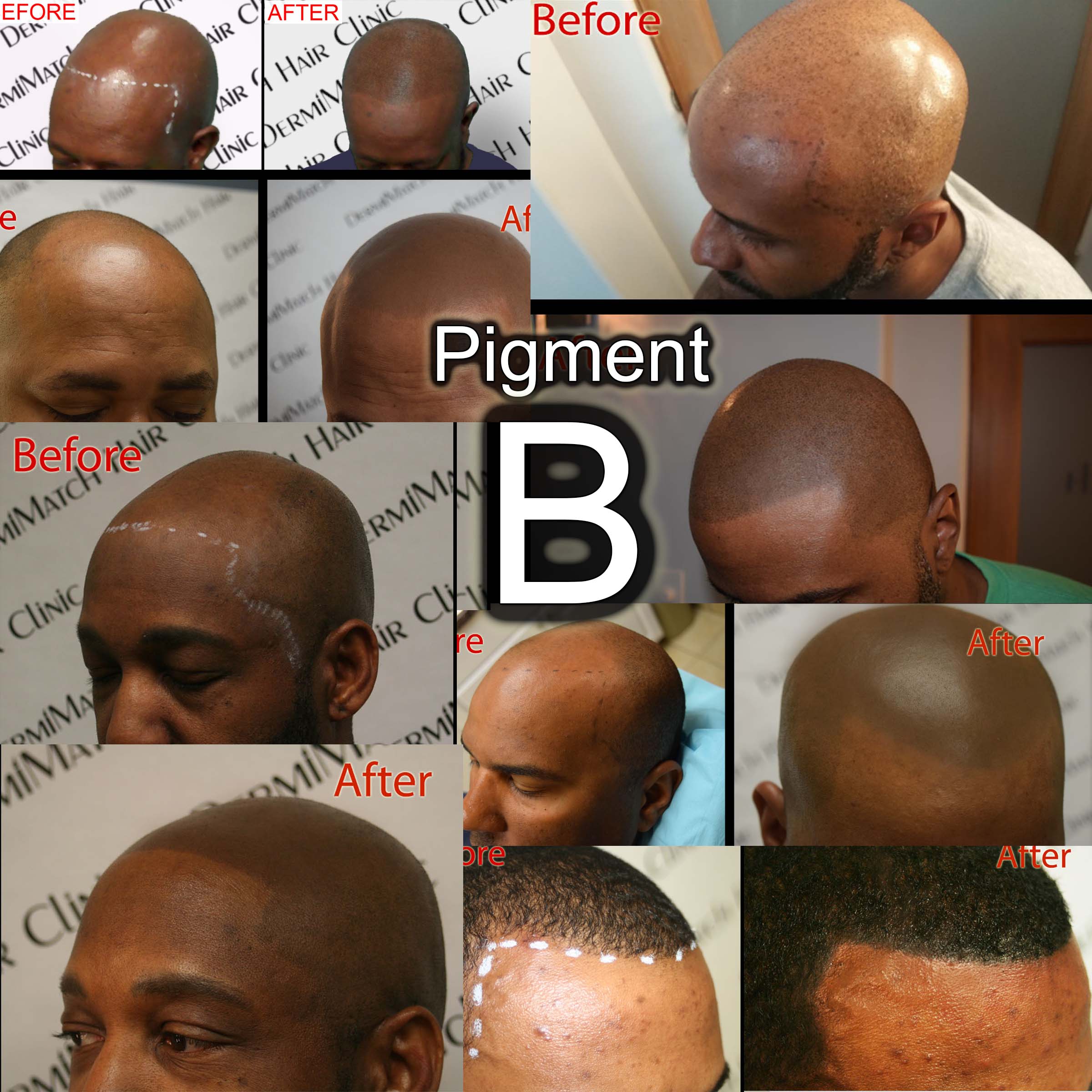 3-Pack HD Scalp Pigments by DermMicro (SMP ink) - Image 5