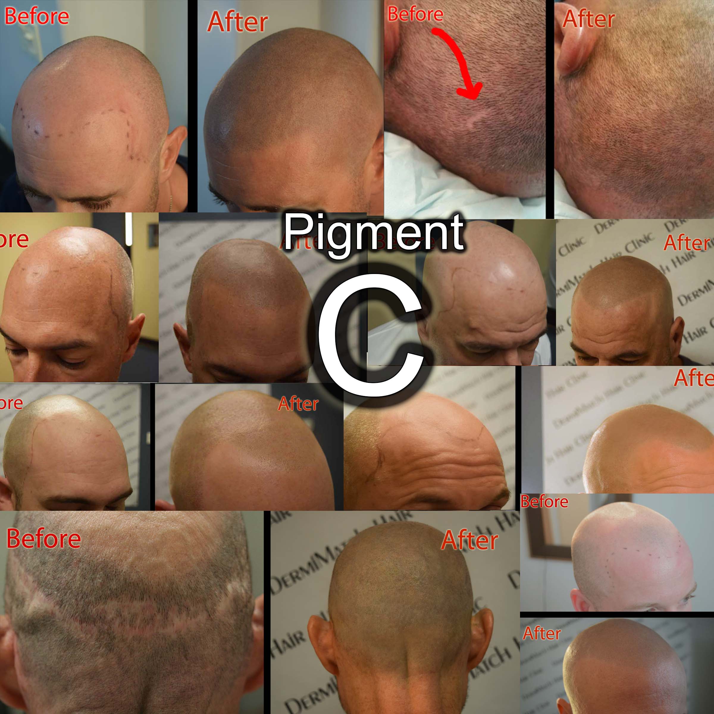 The DermMicro HD Pen - For Scalp Micropigmentation Professionals - Image 4