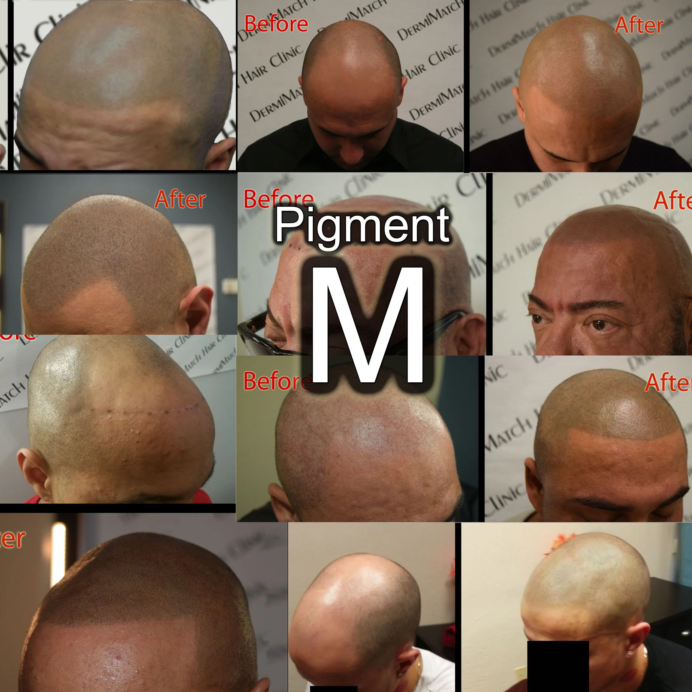 The DermMicro HD Pen - For Scalp Micropigmentation Professionals - Image 5
